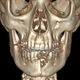 A computed tomography scan showing the lateral jaw fracture, bone loss, and missing teeth.